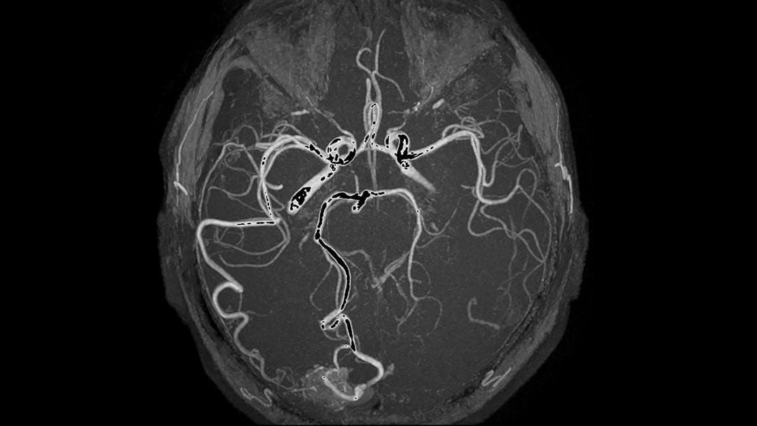 Temporoparietal brain hemorrhage shown on an MRI scan