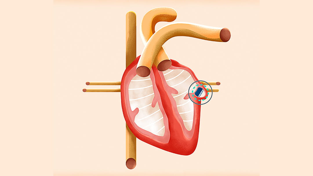 NextGeneration Devices for AFib Offer an Alternative to Blood Thinners