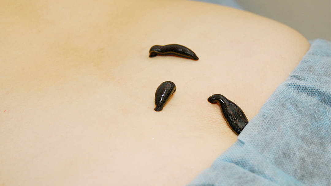 How Leeches Can Save Lives And Limbs for Some Patients