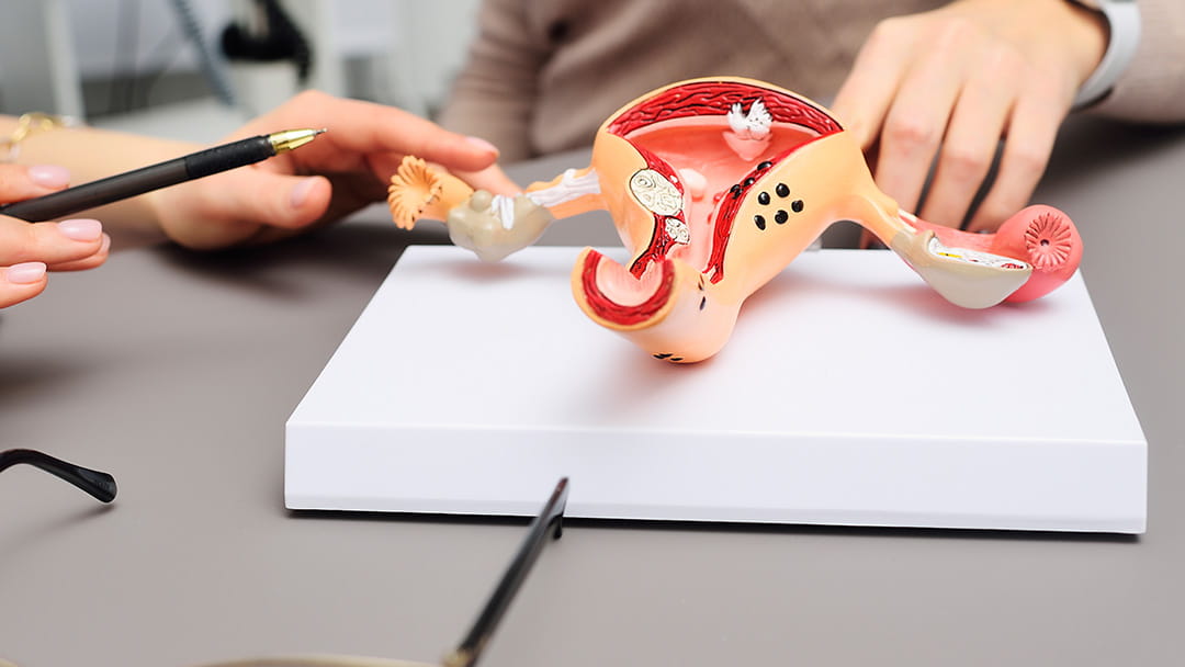 Fallopian Tube Removal May Help Prevent Ovarian Cancer University