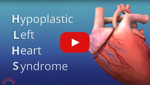 Click to watch the Hypoplastic Left Heart Syndrome video