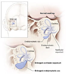 Medical illustration of EVA courtesy of the National Institutes of Health, Department of Health and Human Services
