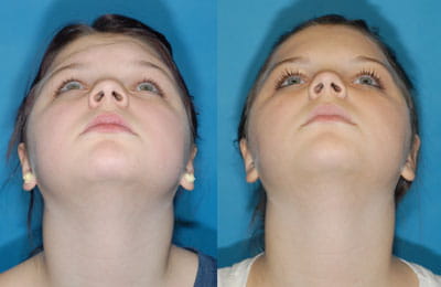 Removal of Fibrous Dysplasia of Brow and Left Supraorbital Region