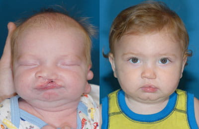 Unilateral Cleft Lip