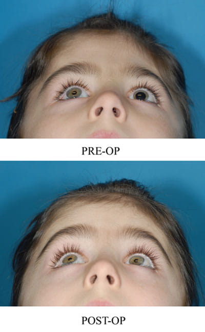 Left Unicoronal Synostosis Cranial-Vault Remodeling at infancy followed by Bilateral Canthopexy, and Bilateral Contouring of Forehead