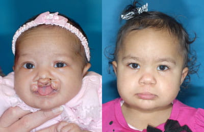 Patient started with Nasal Alveolar Molding (NAM), then proceeded with first surgery: Bilateral Cleft Lip Adhesion followed by second Cleft Lip and Cleft Rhinoplasty