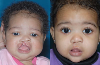Unilateral Cleft Lip (left image pre-op; right image post-op)