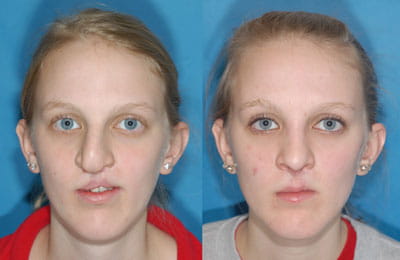 Abbe Flap, Cleft Septorhinoplasty (left image pre-op; right image post-op)