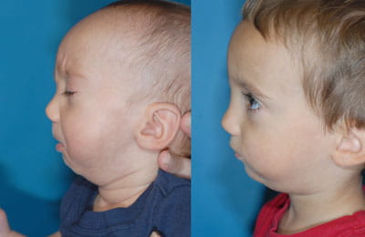 Hemifacial Microsomia: Jaw Reconstruction with Rib Graft (left cheek; left image pre-op; right image post-op)