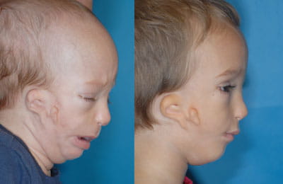 Hemifacial Microsomia: Jaw Reconstruction with Rib Graft (right cheek; left image pre-op; right image post-op)