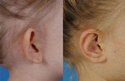 Bilateral Otoplasty (right cheek view close-up; left image pre-op; right image post-op)