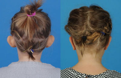 Bilateral Otoplasty (back of head view; left image pre-op; right image post-op)