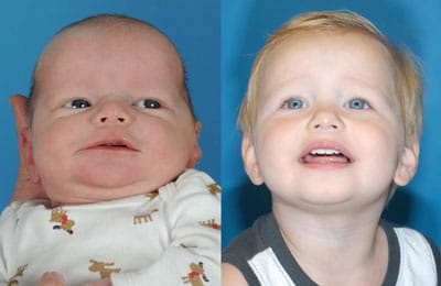 Craniosynostosis (second before after image full face view; left image younger and pre-op; right image older and post-op)