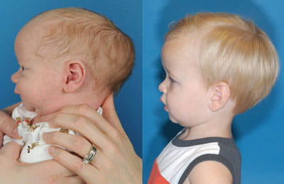 Craniosynostosis (left full cheek view; left image younger and pre-op; right image older and post-op)