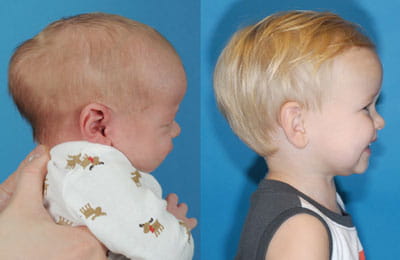 Craniosynostosis (right full cheek view; left image younger and pre-op; right image older and post-op)