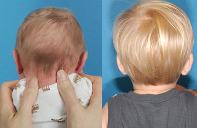 Craniosynostosis (back of head view; left image younger and pre-op; right image older and post-op)
