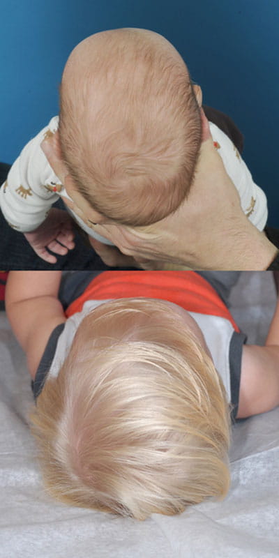 Craniosynostosis (top of head view; top image younger and pre-op; bottom image older and post-op)