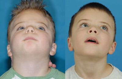 Left Unicoronal Synostosis Cranial Vault remodeling at infancy followed by Bilateral Contouring of Forehead (left image pre-op; right image post-op)