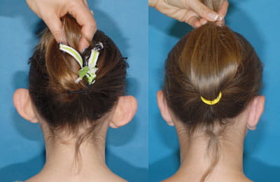 Bilateral Otoplasty (back of head view; left image pre-op; right image post-op)