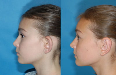 Bilateral Otoplasty (full left cheek view; left image pre-op; right image post-op)