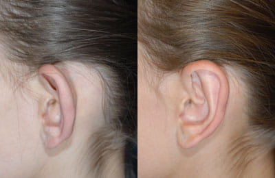 Bilateral Otoplasty (close-up left ear view; left image pre-op; right image post-op)