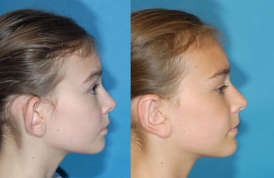 Bilateral Otoplasty (full cheek right ear view; left image pre-op; right image post-op)