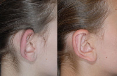 Bilateral Otoplasty (close-up right ear view; left image pre-op; right image post-op)