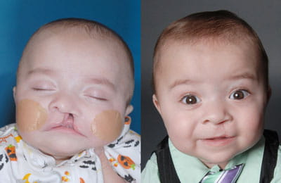 Unilateral Cleft Lip (left image pre-op; right image post-op)