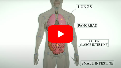 Click to watch the Treatments for Neuroendocrine Tumors video