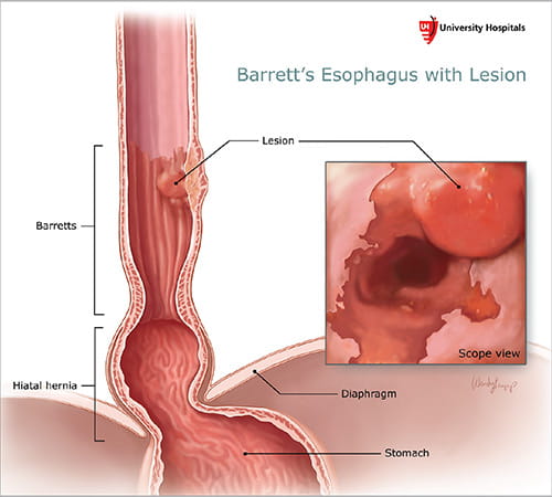 Illustration: Barrett’s Esophagus with Lesion