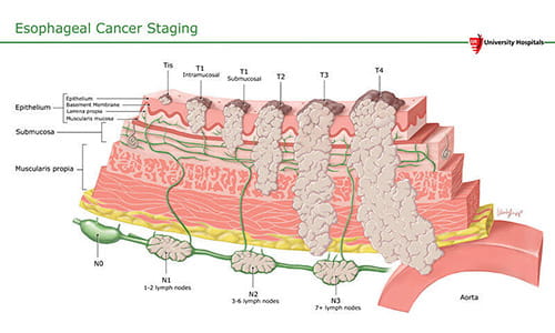 Illustration: Esophageal Cancer Staging