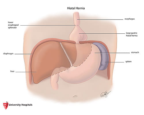 Illustration of a Hiatal Hernia