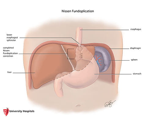 Illustration: Nissen Fundoplication procedure