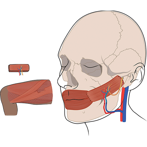 Diagram of a Gracilis muscle transfer