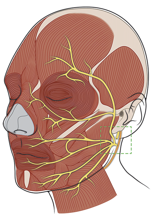 Diagram of a Hypoglossal Nerve Transfer