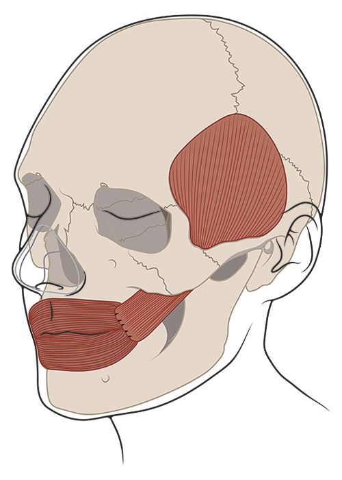 Diagram of a Temporalis tendon transfer