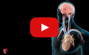 Watch the Stroke Prevention in Patients with Afib Video