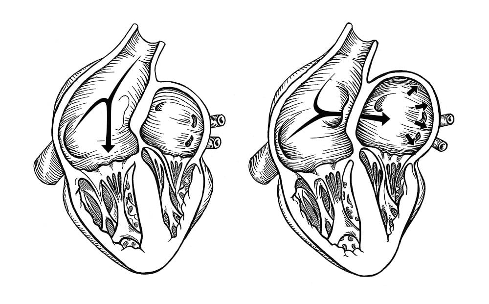 Comparison of normal heart versus heart with a patent foramen ovale