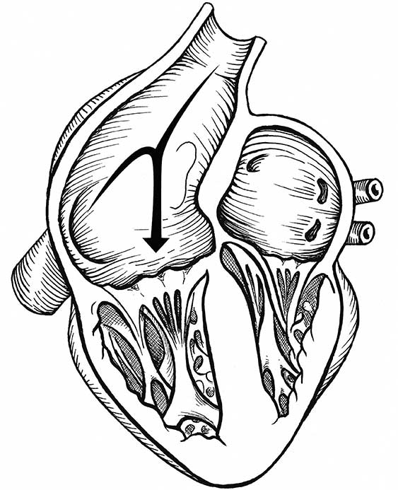 Drawing of a normal heart, the foramen ovale has closed, separating the right atrium from the left atrium.