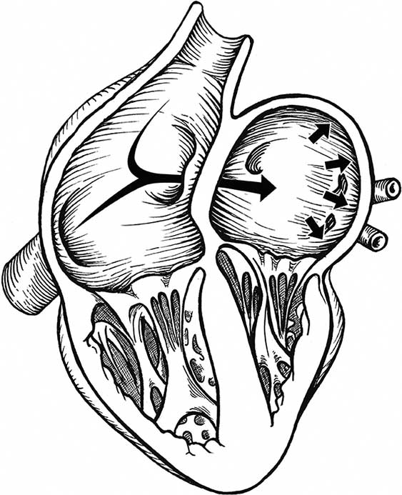 Drawing of a heart with a PFO, blood leaks from the right atrium into the left atrium, then out to the body.