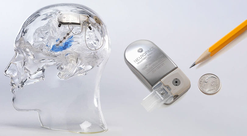 NeuroPace® RNS® Neurostimulator with Clear Model