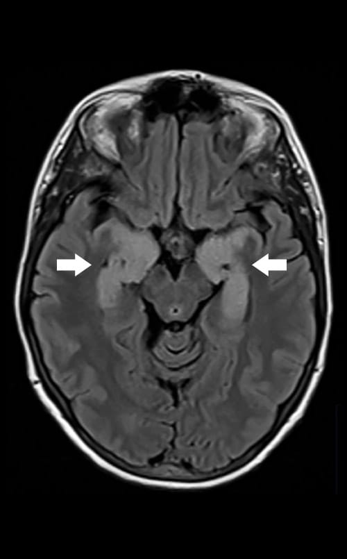 Arrows on an MRI image point to inflammation of the limbic system in a patient with autoimmune encephalitis.