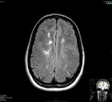 An MRI image showing areas of inflammation and scarring in the brain of an MS patient