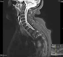 An MRI image showing a long area of inflammation in the spinal cord of a patient with NMO