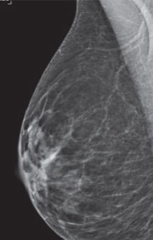 Breast Density Scattered Areas of Fibroglandular Density