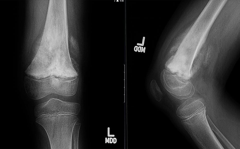 X-ray image of Osteosarcoma