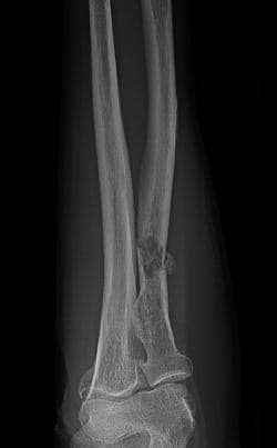 X-ray image showing cancer cells spreading to bone