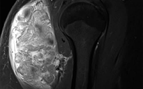 X-ray image of Shoulder Sarcoma