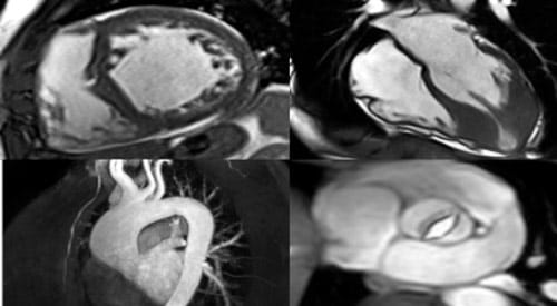 Some results from a Cardiovascular MRI