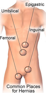 Is a bulge after hernia surgery normal? - ClinicaHealth